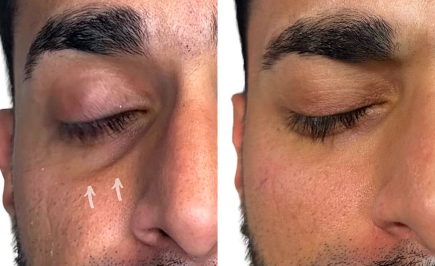 Tear Trough Filler Before & After - Dr Hass Clinic