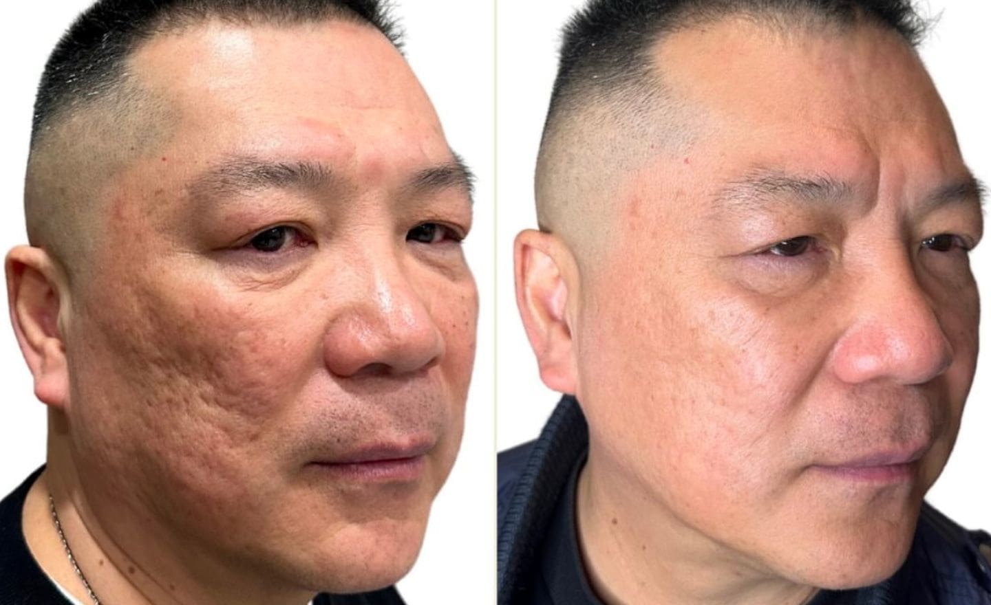 Before and After Microneedling - Dr Hass Clinic