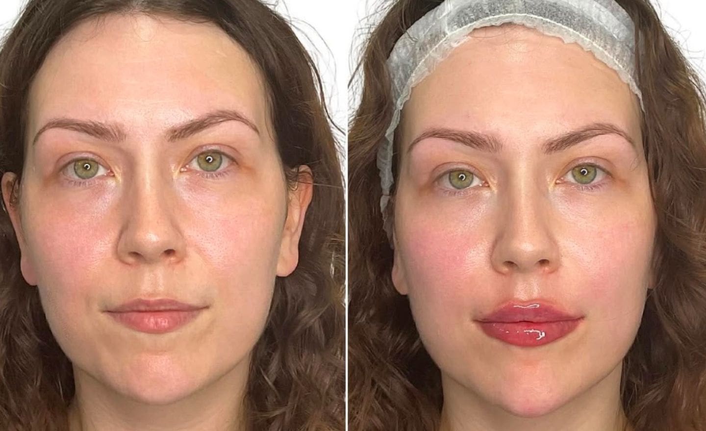 Cosmetic Procedures- lip filler