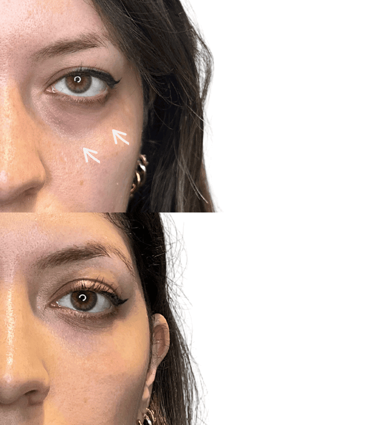 Tear Trough Filler Before and After - Female Patient at Dr Hass Clinic in Mayfair