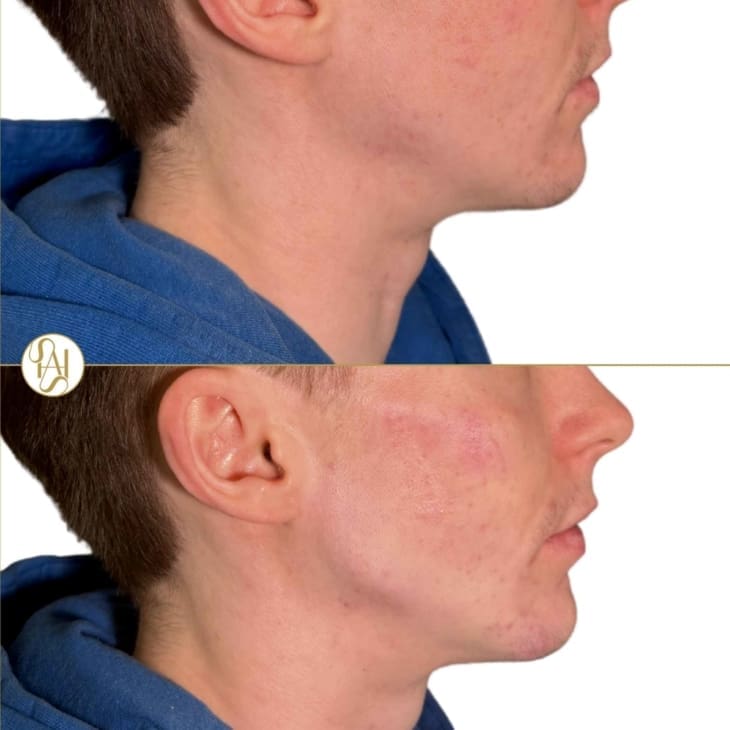 Facial Masculinisation Before and After - Dr Hass Clinic