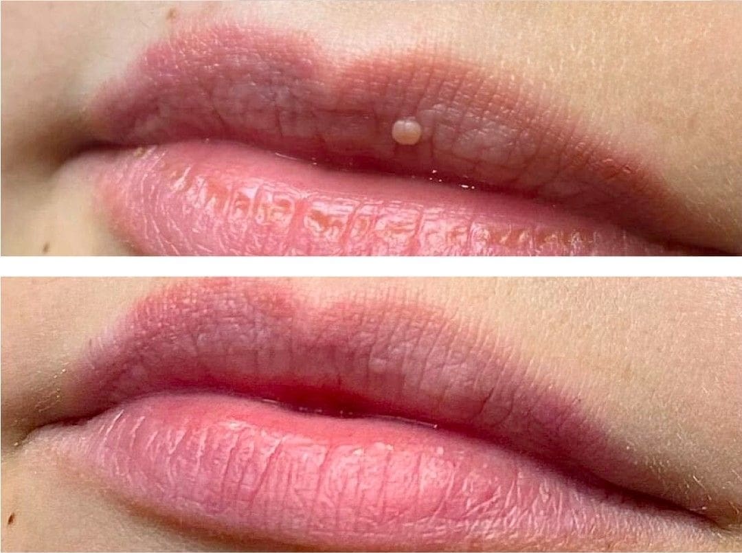 Cryopen Before and After Lips - Dr Hass Clinic