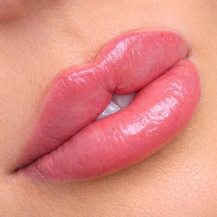 Russian Lip Technique vs Classic Lip Filler