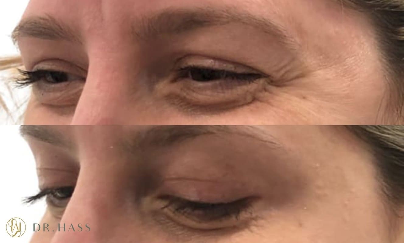 Crow's Feet - Before and After Anti Wrinkle Injections - Dr Hass Clinic