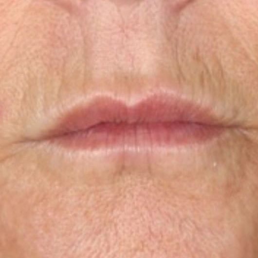 Result 4: lines around the mouth
