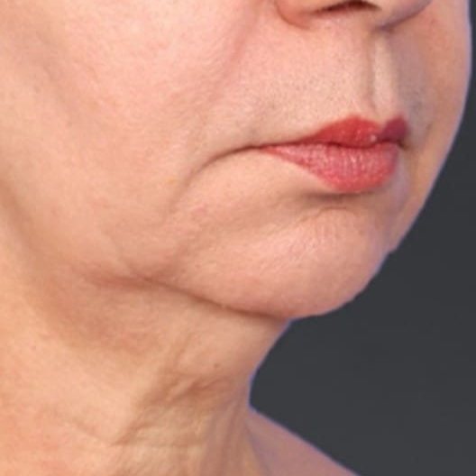 Result 2: lower face