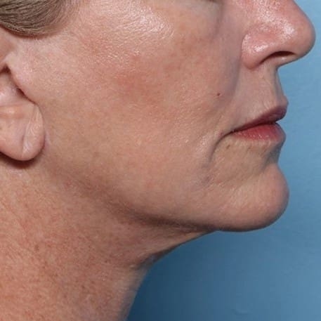 Result 3: jawline profile