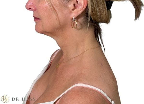 TrapeziusBotoxAfter-DrHassClinic