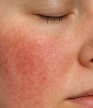 skin-redness